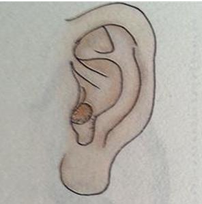 耳前瘘管怎么办