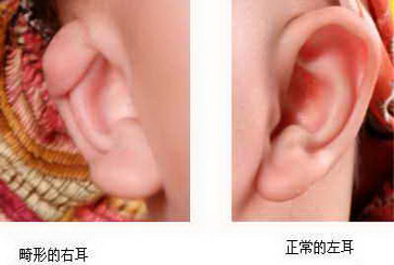 耳朵畸形是什么